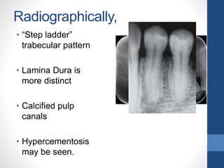 Radiographically,
• “Step ladder”
trabecular pattern
• Lamina Dura is
more distinct
• Calcified pulp
canals
• Hypercementosis
may be seen.
 