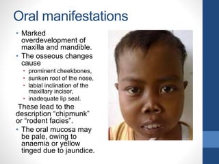 Oral manifestations
• Marked
overdevelopment of
maxilla and mandible.
• The osseous changes
cause
• prominent cheekbones,
• sunken root of the nose,
• labial inclination of the
maxillary incisor,
• inadequate lip seal.
These lead to the
description “chipmunk”
or “rodent facies”.
• The oral mucosa may
be pale, owing to
anaemia or yellow
tinged due to jaundice.
 
