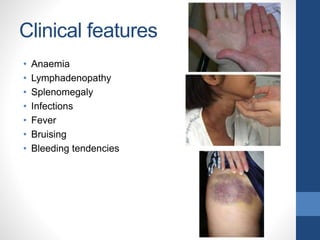 Clinical features
• Anaemia
• Lymphadenopathy
• Splenomegaly
• Infections
• Fever
• Bruising
• Bleeding tendencies
 