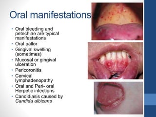 Oral manifestations
• Oral bleeding and
petechiae are typical
manifestations
• Oral pallor
• Gingival swelling
(sometimes)
• Mucosal or gingival
ulceration
• Pericoronitis
• Cervical
lymphadenopathy
• Oral and Peri- oral
Herpetic infections
• Candidiasis caused by
Candida albicans
 