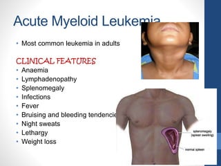 Acute Myeloid Leukemia
• Most common leukemia in adults
CLINICAL FEATURES
• Anaemia
• Lymphadenopathy
• Splenomegaly
• Infections
• Fever
• Bruising and bleeding tendencies
• Night sweats
• Lethargy
• Weight loss
 