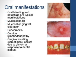 Oral manifestations
• Oral bleeding and
petechiae are typical
manifestations
• Mucosal pallor
• Mucosal or gingival
ulceration
• Pericoronitis
• Cervical
lymphadenopathy
• Gingival swelling
(sometimes)- occurs
due to abnormal
response to dental
plaque
 