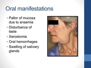 Oral manifestations
• Pallor of mucosa
due to anaemia
• Disturbance of
taste
• Xerostomia
• Oral hemorrhages
• Swelling of salivary
glands
 