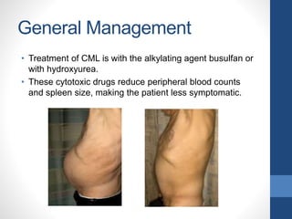 General Management
• Treatment of CML is with the alkylating agent busulfan or
with hydroxyurea.
• These cytotoxic drugs reduce peripheral blood counts
and spleen size, making the patient less symptomatic.
 