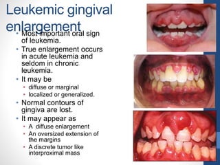 Leukemic gingival
enlargement• Most important oral sign
of leukemia.
• True enlargement occurs
in acute leukemia and
seldom in chronic
leukemia.
• It may be
• diffuse or marginal
• localized or generalized.
• Normal contours of
gingiva are lost.
• It may appear as
• A diffuse enlargement
• An oversized extension of
the margins
• A discrete tumor like
interproximal mass
 