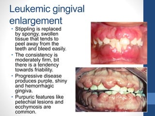 Leukemic gingival
enlargement
• Stippling is replaced
by spongy, swollen
tissue that tends to
peel away from the
teeth and bleed easily.
• The consistency is
moderately firm, bit
there is a tendency
towards friability.
• Progressive disease
produces purple, shiny
and hemorrhagic
gingiva.
• Purpuric features like
petechial lesions and
ecchymosis are
common.
 