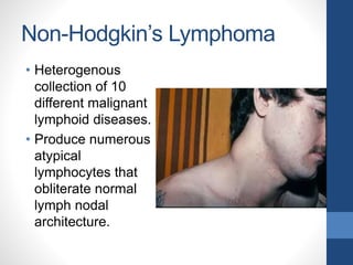 Non-Hodgkin’s Lymphoma
• Heterogenous
collection of 10
different malignant
lymphoid diseases.
• Produce numerous
atypical
lymphocytes that
obliterate normal
lymph nodal
architecture.
 