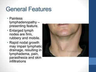 General Features
• Painless
lymphadenopathy –
presenting feature.
• Enlarged lymph
nodes are firm,
rubbery and mobile.
• Rapid nodal growth
may impair lymphatic
drainage, resulting in
lymphadema, pain,
parasthesia and skin
infiltrations
 