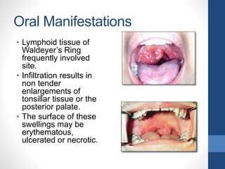 Oral Manifestations
• Lymphoid tissue of
Waldeyer’s Ring
frequently involved
site.
• Infiltration results in
non tender
enlargements of
tonsillar tissue or the
posterior palate.
• The surface of these
swellings may be
erythematous,
ulcerated or necrotic.
 