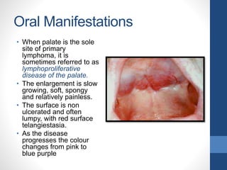 Oral Manifestations
• When palate is the sole
site of primary
lymphoma, it is
sometimes referred to as
lymphoproliferative
disease of the palate.
• The enlargement is slow
growing, soft, spongy
and relatively painless.
• The surface is non
ulcerated and often
lumpy, with red surface
telangiestasia.
• As the disease
progresses the colour
changes from pink to
blue purple
 