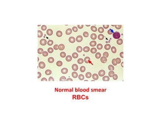Normal blood smear
RBCs
 
