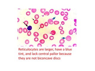 Reticulocytes are larger, have a blue
tint, and lack central pallor because
they are not biconcave discs
 