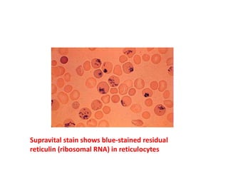 Supravital stain shows blue-stained residual
reticulin (ribosomal RNA) in reticulocytes
 