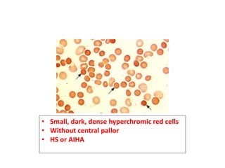 • Small, dark, dense hyperchromic red cells
• Without central pallor
• HS or AIHA
 