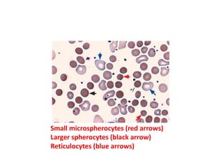 Small microspherocytes (red arrows)
Larger spherocytes (black arrow)
Reticulocytes (blue arrows)
 