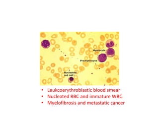• Leukcoerythroblastic blood smear
• Nucleated RBC and immature WBC.
• Myelofibrosis and metastatic cancer
 