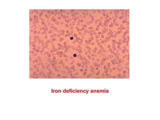 Iron deficiency anemia
 