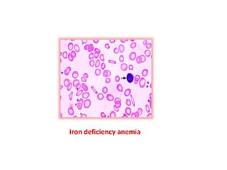 Iron deficiency anemia
 