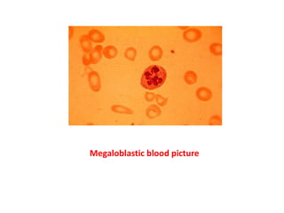 Megaloblastic blood picture
 