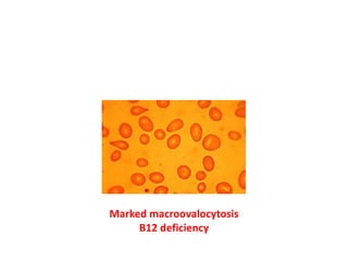Marked macroovalocytosis
B12 deficiency
 