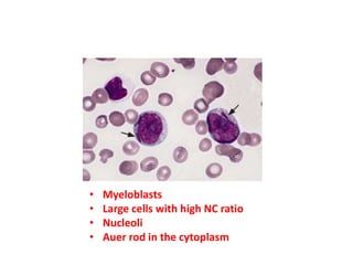 • Myeloblasts
• Large cells with high NC ratio
• Nucleoli
• Auer rod in the cytoplasm
 