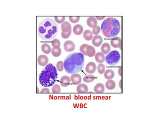 Normal blood smear
WBC
 