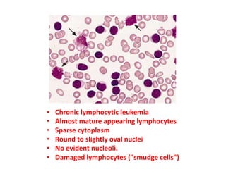 • Chronic lymphocytic leukemia
• Almost mature appearing lymphocytes
• Sparse cytoplasm
• Round to slightly oval nuclei
• No evident nucleoli.
• Damaged lymphocytes ("smudge cells")
 