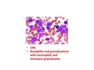 • CML
• Basophilia and granulocytosis
with neutrophils and
immature granulocytes
 