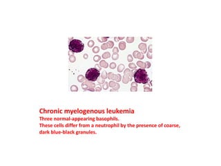 Chronic myelogenous leukemia
Three normal-appearing basophils.
These cells differ from a neutrophil by the presence of coarse,
dark blue-black granules.
 