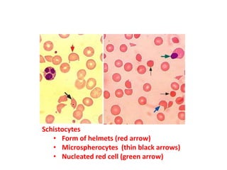 Schistocytes
• Form of helmets (red arrow)
• Microspherocytes (thin black arrows)
• Nucleated red cell (green arrow)
 