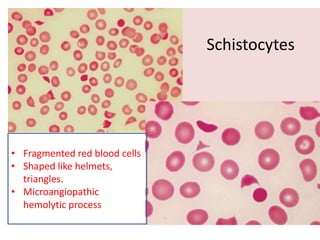 Schistocytes
• Fragmented red blood cells
• Shaped like helmets,
triangles.
• Microangiopathic
hemolytic process
 