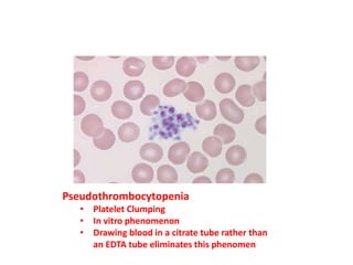 Pseudothrombocytopenia
• Platelet Clumping
• In vitro phenomenon
• Drawing blood in a citrate tube rather than
an EDTA tube eliminates this phenomen
 