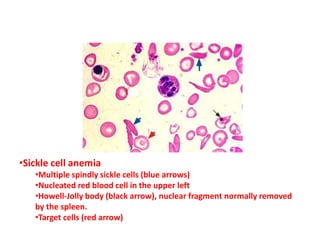 •Sickle cell anemia
•Multiple spindly sickle cells (blue arrows)
•Nucleated red blood cell in the upper left
•Howell-Jolly body (black arrow), nuclear fragment normally removed
by the spleen.
•Target cells (red arrow)
 