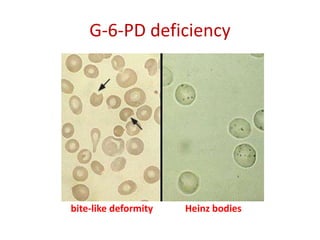 bite-like deformity Heinz bodies
G-6-PD deficiency
 