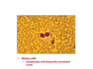 • Sézary cells
• Lymphocytes with frequently convoluted
nuclei
 