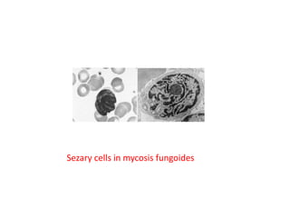 Sezary cells in mycosis fungoides
 