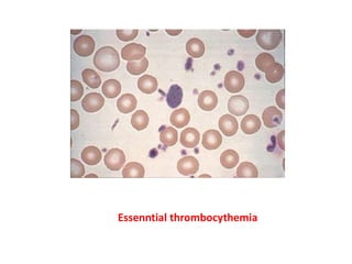 Essenntial thrombocythemia
 
