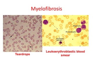 Myelofibrosis
Leukoerythroblastic blood
smearTeardrops
 