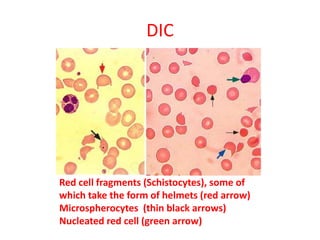 Red cell fragments (Schistocytes), some of
which take the form of helmets (red arrow)
Microspherocytes (thin black arrows)
Nucleated red cell (green arrow)
DIC
 
