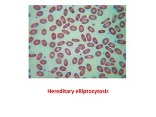 Hereditary elliptocytosis
 