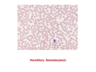 Hereditary Stomatocytosis
 
