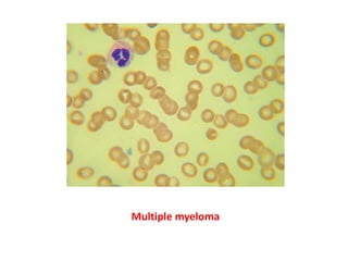 Multiple myeloma
 