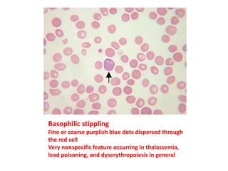 Basophilic stippling
Fine or coarse purplish blue dots dispersed through
the red cell
Very nonspecific feature occurring in thalassemia,
lead poisoning, and dyserythropoiesis in general
 