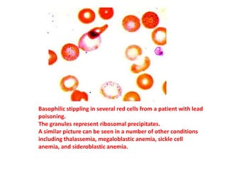 Basophilic stippling in several red cells from a patient with lead
poisoning.
The granules represent ribosomal precipitates.
A similar picture can be seen in a number of other conditions
including thalassemia, megaloblastic anemia, sickle cell
anemia, and sideroblastic anemia.
 