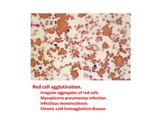 Red cell agglutination.
Irregular aggregates of red cells
Mycoplasma pneumoniae infection.
Infectious mononucleosis
Chronic cold hemagglutinin disease
 