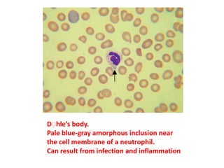 Dِ hle’s body.
Pale blue-gray amorphous inclusion near
the cell membrane of a neutrophil.
Can result from infection and inflammation
 