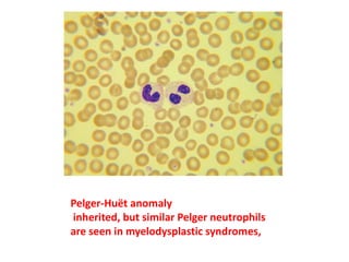 Pelger-Huët anomaly
inherited, but similar Pelger neutrophils
are seen in myelodysplastic syndromes,
 