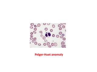 Pelger-Huet anomaly
 