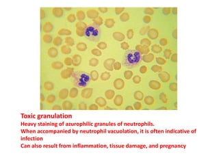 Toxic granulation
Heavy staining of azurophilic granules of neutrophils.
When accompanied by neutrophil vacuolation, it is often indicative of
infection
Can also result from inflammation, tissue damage, and pregnancy
 
