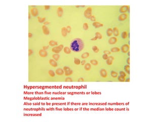 Hypersegmented neutrophil
More than five nuclear segments or lobes
Megaloblastic anemia
Also said to be present if there are increased numbers of
neutrophils with five lobes or if the median lobe count is
increased
 